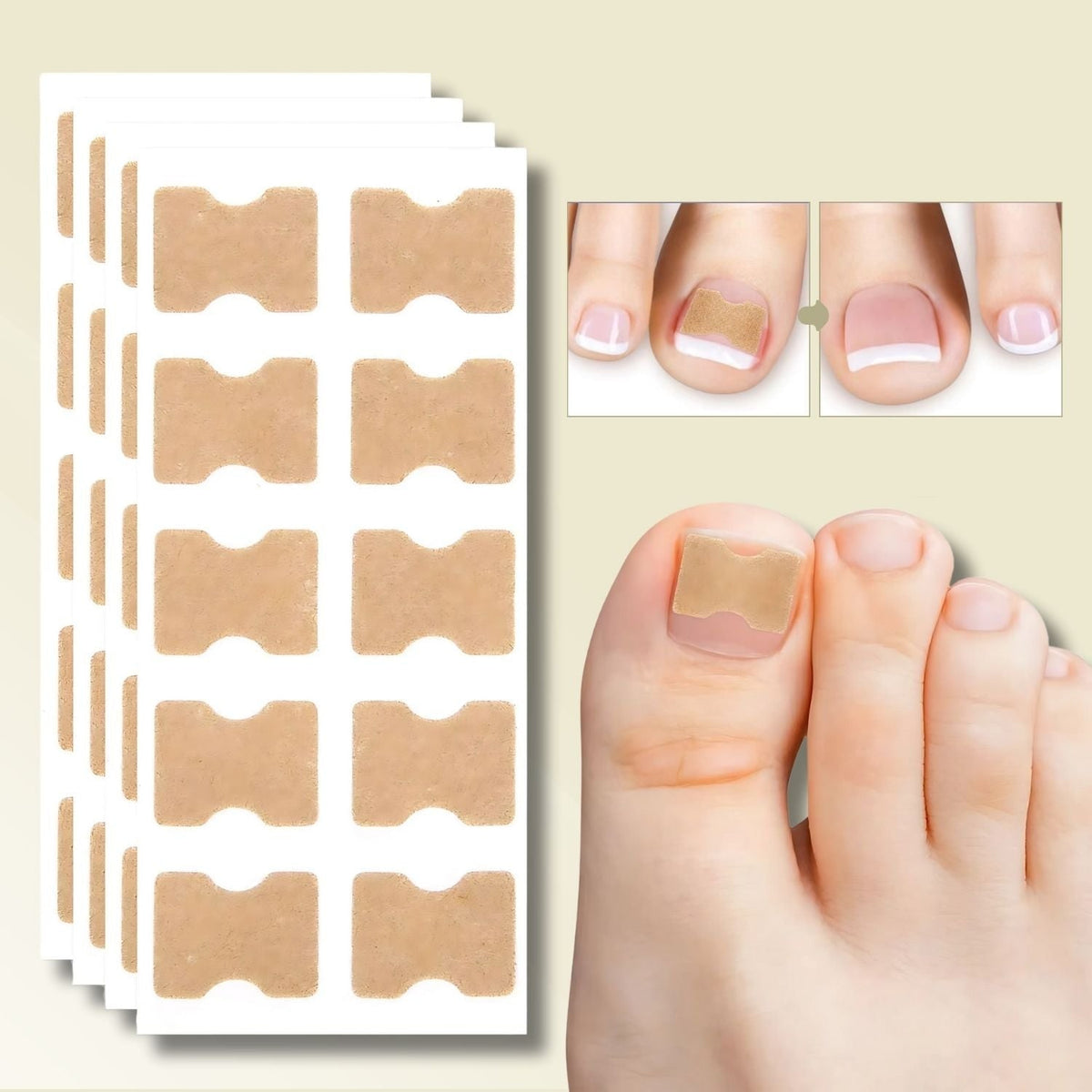 Fungus Nail Patches with Ingrown Toenail Elastic Correction and Peel-Stick Application 20 Count - Image 1