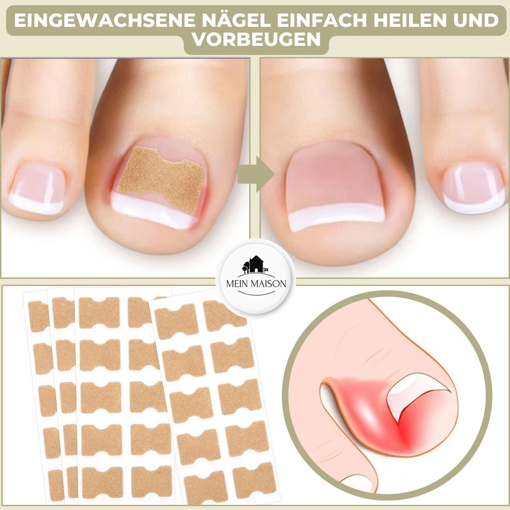 Fungus Nail Patches with Ingrown Toenail Elastic Correction and Peel-Stick Application 20 Count - Image 2