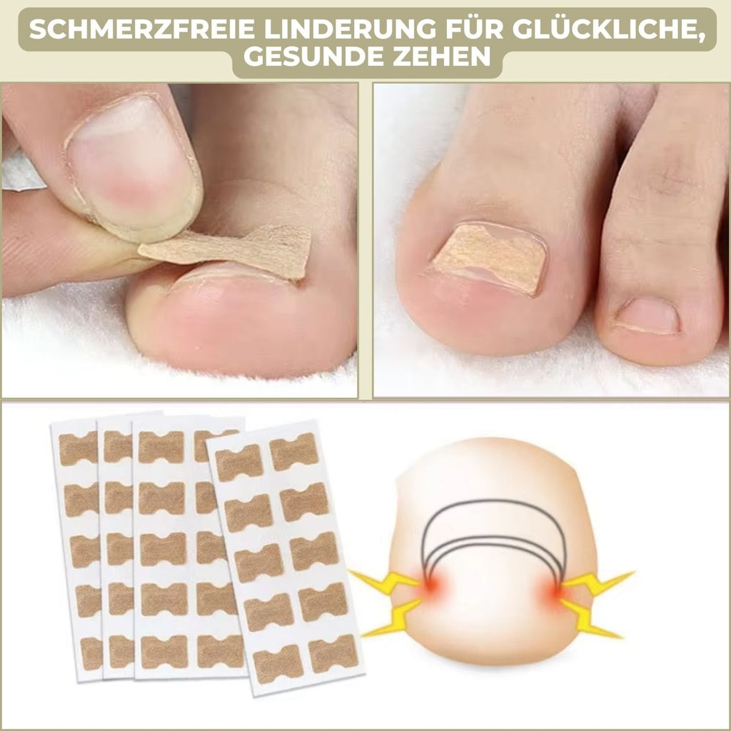 Fungus Nail Patches with Ingrown Toenail Elastic Correction and Peel-Stick Application 20 Count - Image 3
