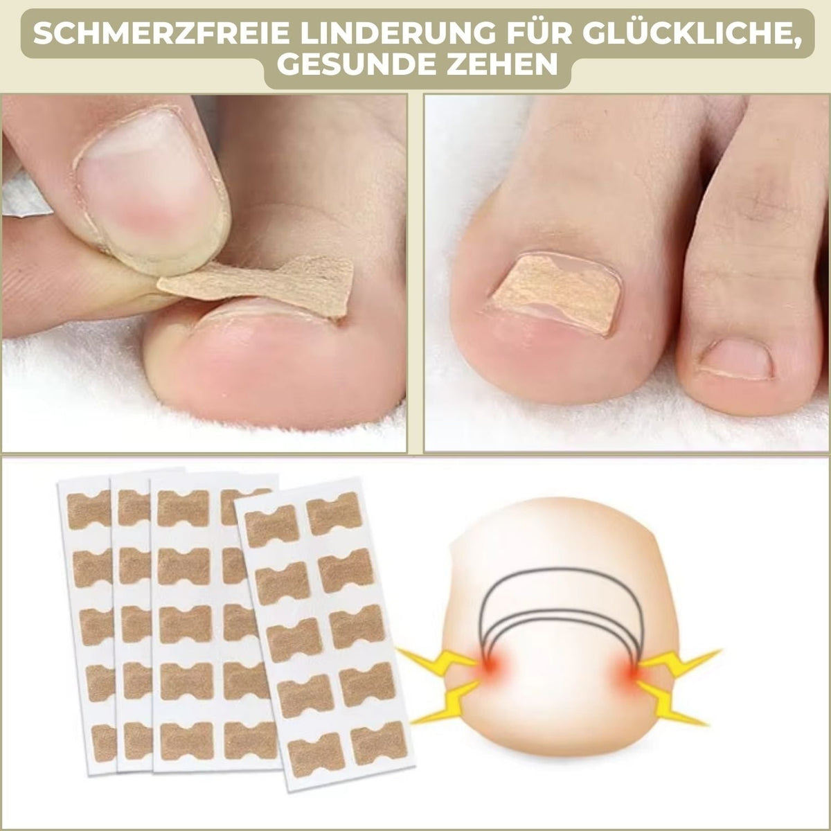 Fungus Nail Patches with Ingrown Toenail Elastic Correction and Peel-Stick Application 20 Count - Image 3