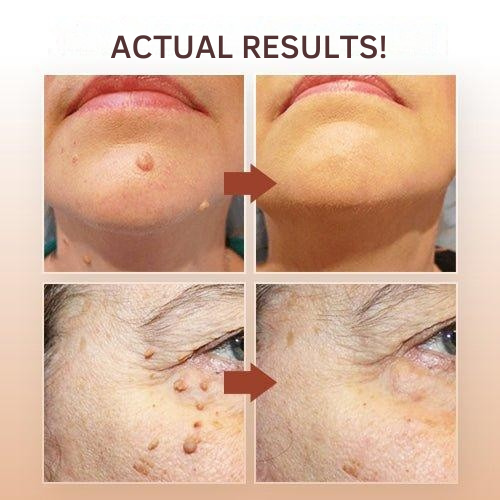 Natural Skin Tag Remover At-Home Wart Pen Brush Tip Liquid - Image 2
