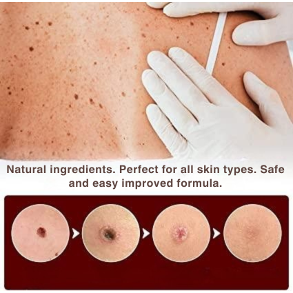Natural Skin Tag Remover At-Home Wart Pen Brush Tip Liquid - Image 3