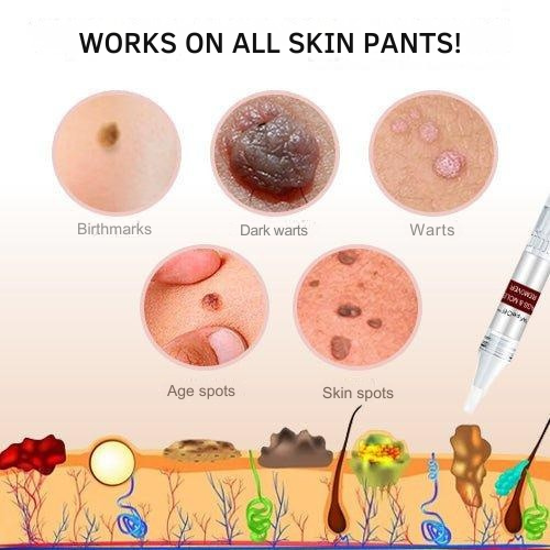 Natural Skin Tag Remover At-Home Wart Pen Brush Tip Liquid - Image 5