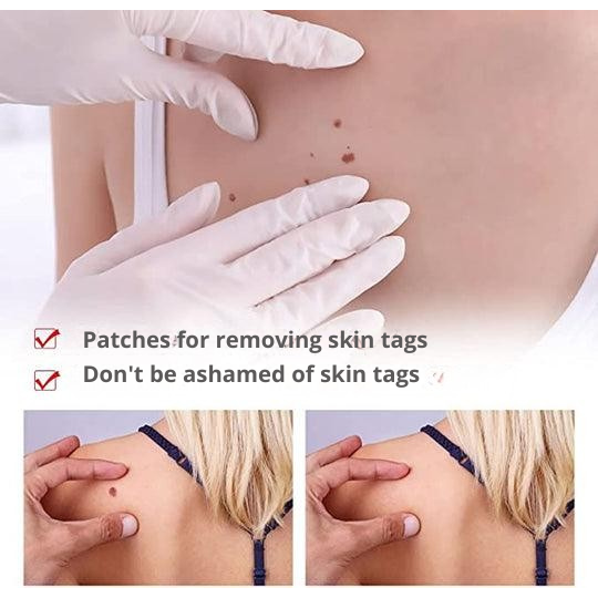 Natural Skin Tag Remover At-Home Wart Pen Brush Tip Liquid - Image 6