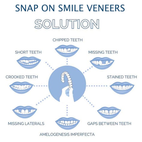 Snap on Veneers Temporary Removable Moldable Teeth Upper Lower - Image 6