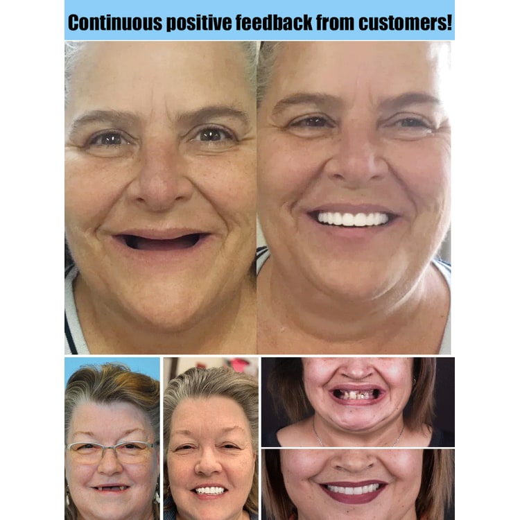 Snap on Veneers Upper and Lower Teeth with Moldable Cosmetic Fake for Customizable Fit - Image 5