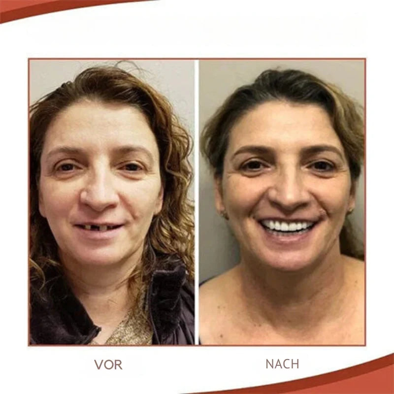 Snap on Veneers with Moldable Thermal Beads for Custom Fit Cosmetic Teeth - Image 5