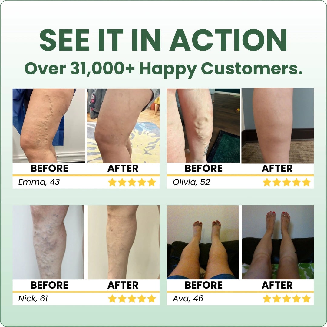 Swelling Cream with Diclofenac Sodium and Horse Chestnut for Varicose Veins Leg Balm - Image 13